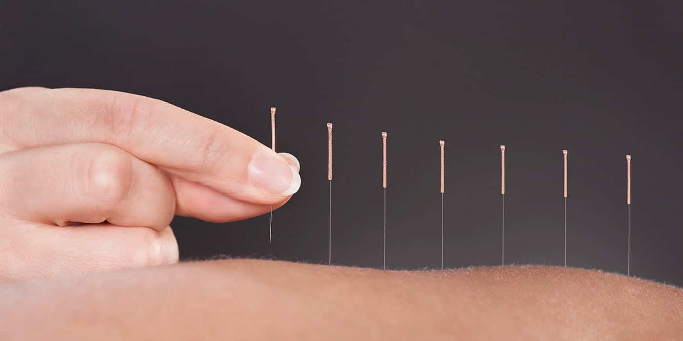 Acupuncture